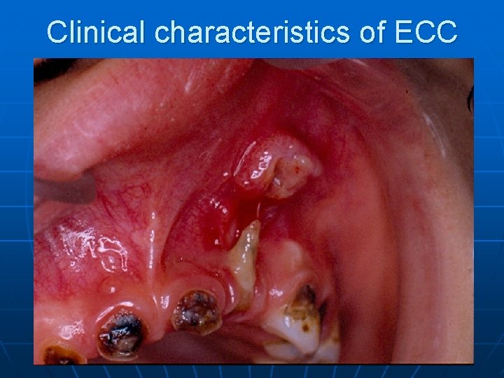 Clinical characteristics of ECC 