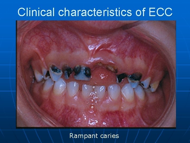 Clinical characteristics of ECC Rampant caries 