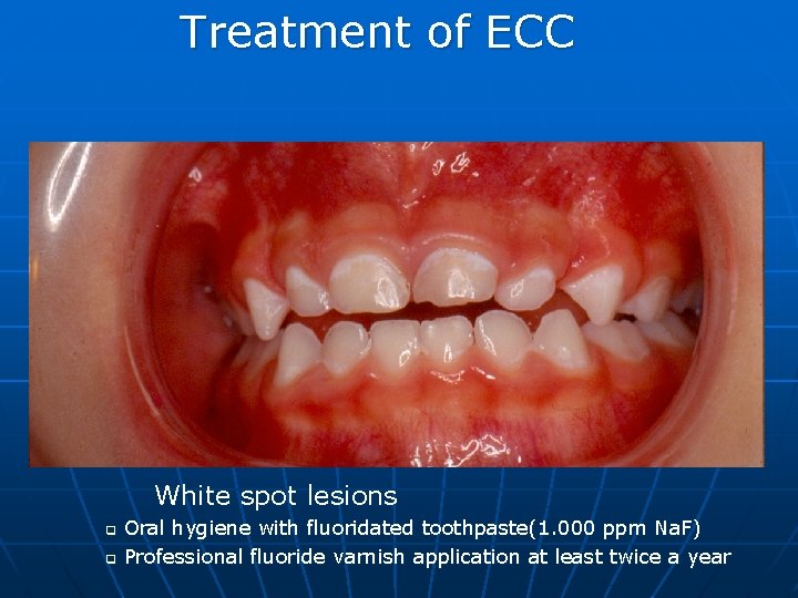 Treatment of ECC White spot lesions q q Oral hygiene with fluoridated toothpaste(1. 000