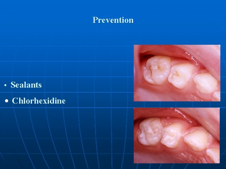 Prevention • Sealants • Chlorhexidine 