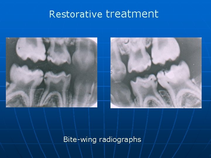 Restorative treatment Bite-wing radiographs 