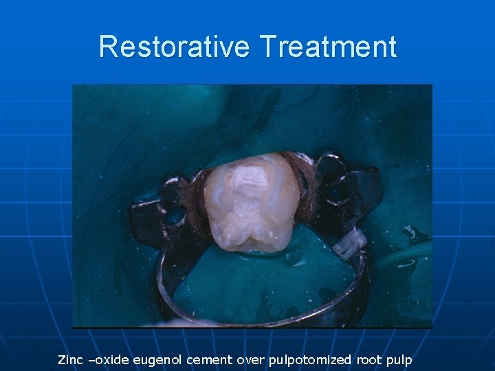 Restorative Treatment Zinc –oxide eugenol cement over pulpotomized root pulp 