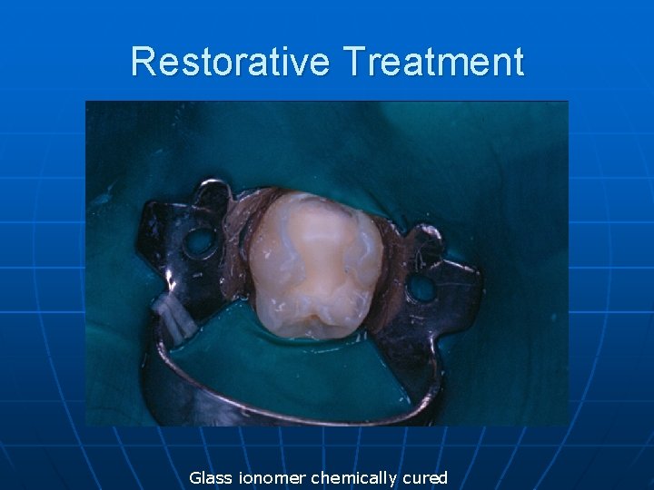 Restorative Treatment Glass ionomer chemically cured 
