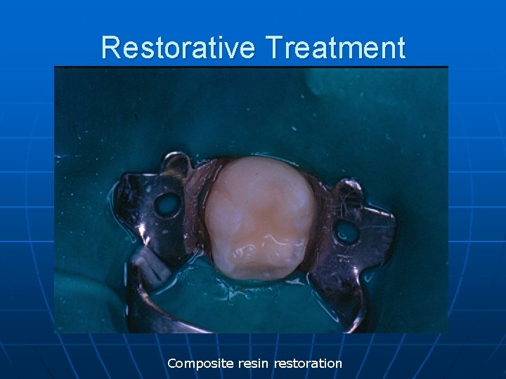 Restorative Treatment Composite resin restoration 