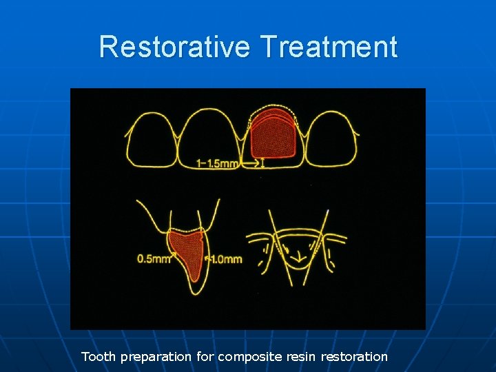 Restorative Treatment Tooth preparation for composite resin restoration 