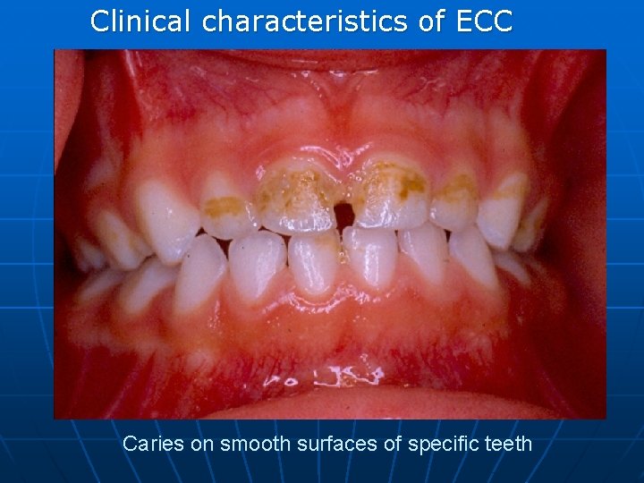 Clinical characteristics of ECC Caries on smooth surfaces of specific teeth 