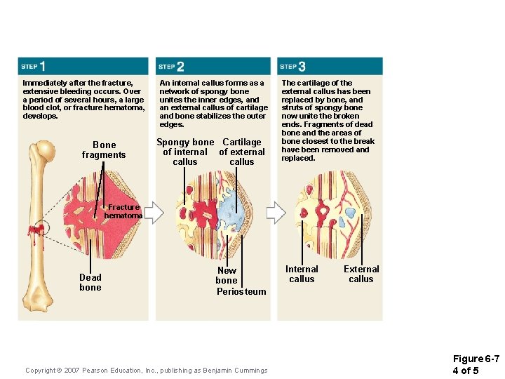 Immediately after the fracture, extensive bleeding occurs. Over a period of several hours, a