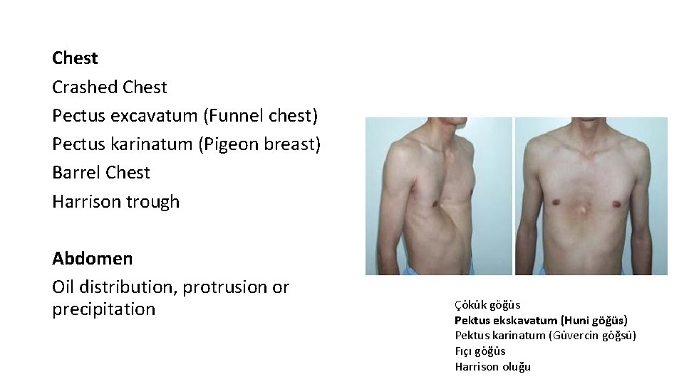 Chest Crashed Chest Pectus excavatum (Funnel chest) Pectus karinatum (Pigeon breast) Barrel Chest Harrison