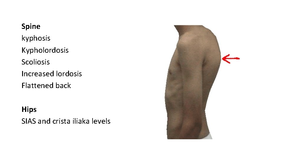 Spine kyphosis Kypholordosis Scoliosis Increased lordosis Flattened back Hips SIAS and crista iliaka levels