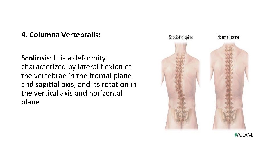 4. Columna Vertebralis: Scoliosis: It is a deformity characterized by lateral flexion of the