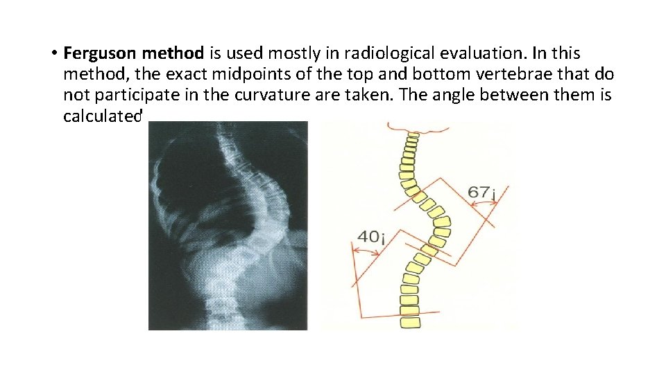  • Ferguson method is used mostly in radiological evaluation. In this method, the