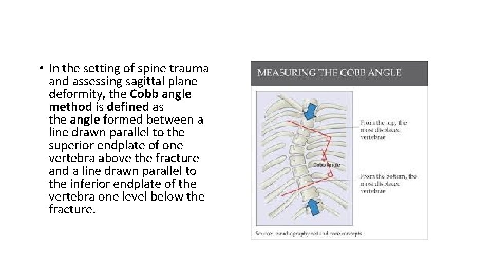 • In the setting of spine trauma and assessing sagittal plane deformity, the