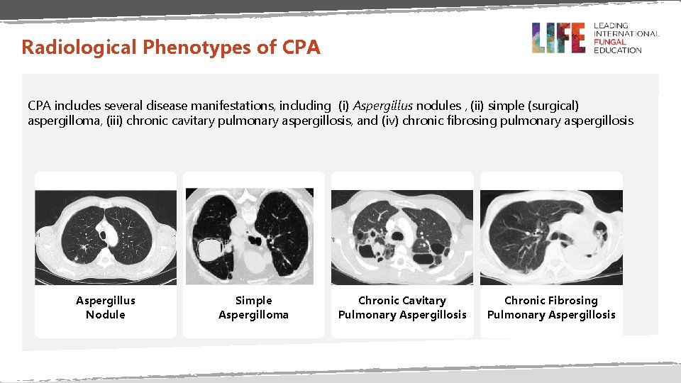 Radiological Phenotypes of CPA includes several disease manifestations, including (i) Aspergillus nodules , (ii)