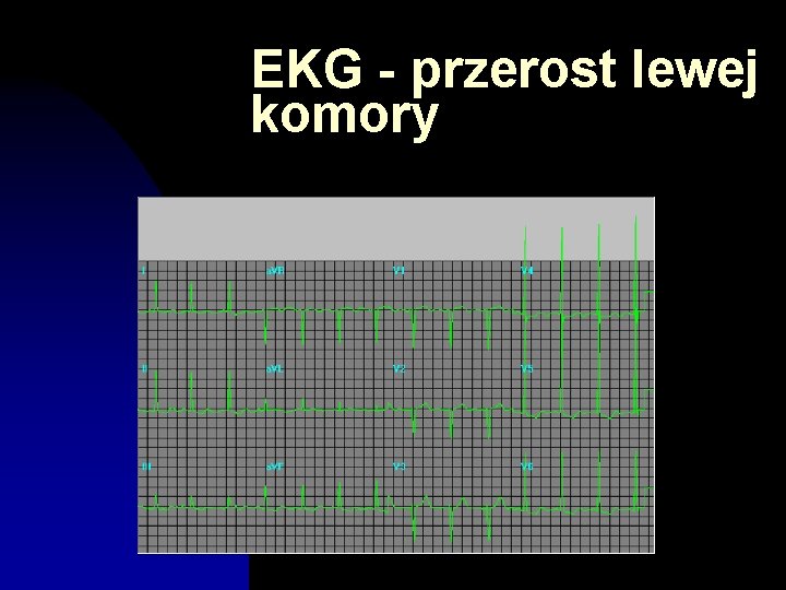 EKG - przerost lewej komory 