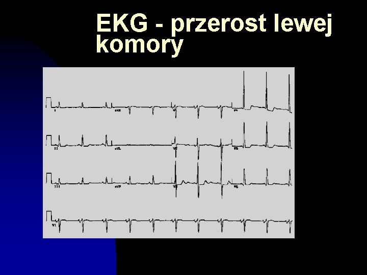 EKG - przerost lewej komory 