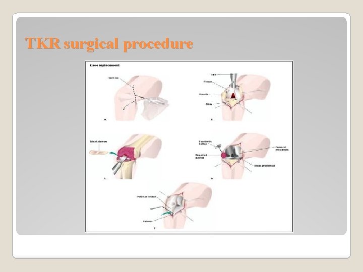 TKR surgical procedure 