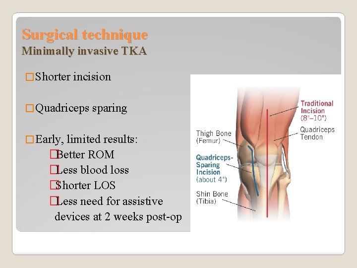 Surgical technique Minimally invasive TKA � Shorter incision � Quadriceps � Early, sparing limited