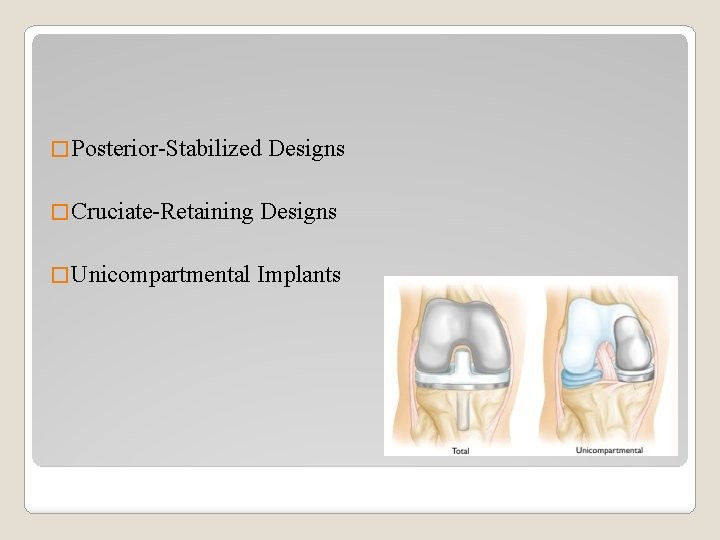 � Posterior-Stabilized Designs � Cruciate-Retaining Designs � Unicompartmental Implants 