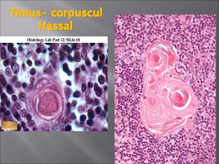 Timus- corpuscul Hassal 