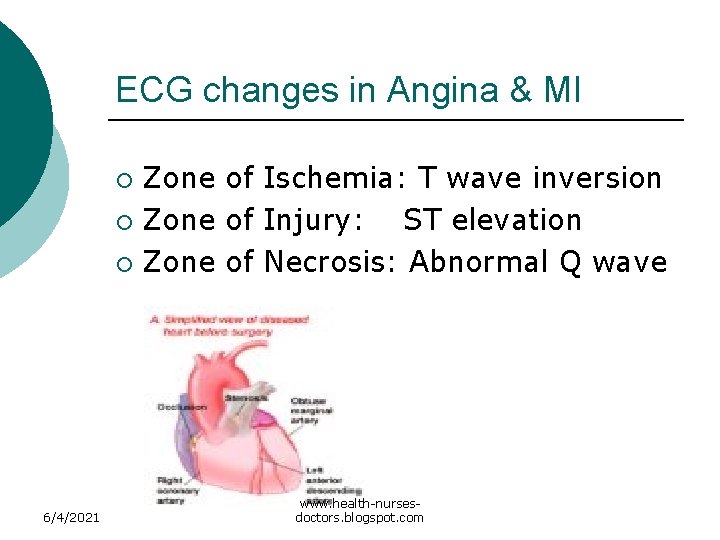 ECG changes in Angina & MI Zone of Ischemia: T wave inversion ¡ Zone