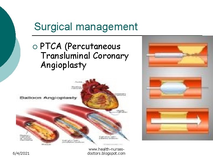 Surgical management ¡ 6/4/2021 PTCA (Percutaneous Transluminal Coronary Angioplasty www. health-nursesdoctors. blogspot. com 