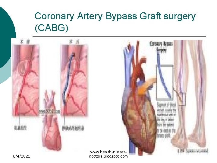 Coronary Artery Bypass Graft surgery (CABG) 6/4/2021 www. health-nursesdoctors. blogspot. com 