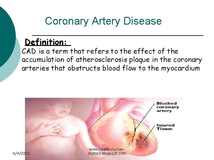 Coronary Artery Disease Definition: CAD is a term that refers to the effect of