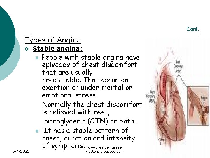 Cont. Types of Angina ¡ Stable angina: l l 6/4/2021 People with stable angina