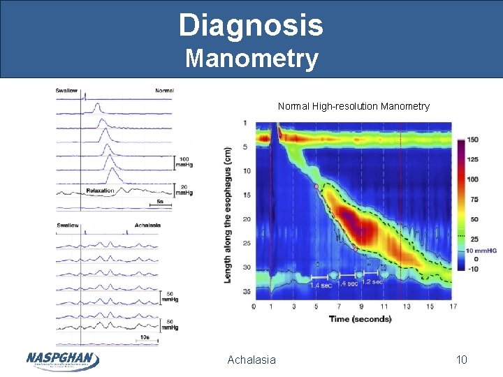 Diagnosis Manometry Normal High-resolution Manometry Achalasia 10 Diagnosis Manometry Normal High-resolution Manometry Achalasia 10