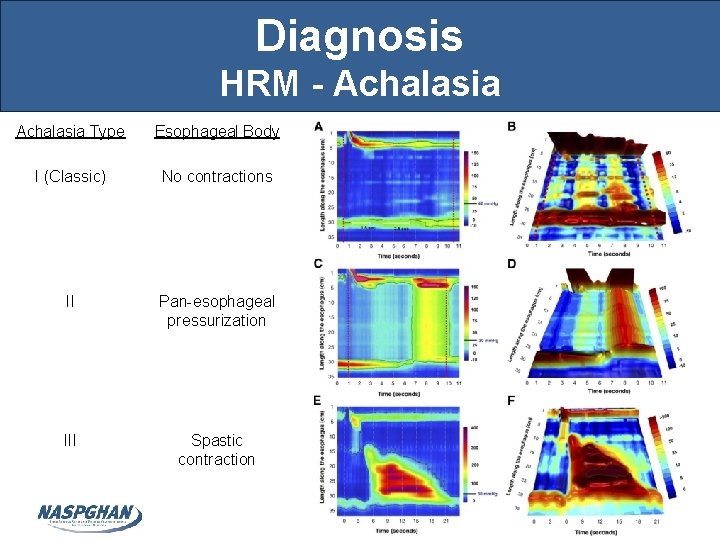 Diagnosis HRM - Achalasia Type Esophageal Body I (Classic) No contractions II Pan-esophageal pressurization Diagnosis HRM - Achalasia Type Esophageal Body I (Classic) No contractions II Pan-esophageal pressurization