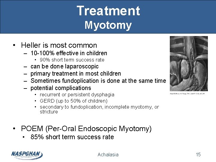 Treatment Myotomy • Heller is most common – 10 -100% effective in children • Treatment Myotomy • Heller is most common – 10 -100% effective in children •