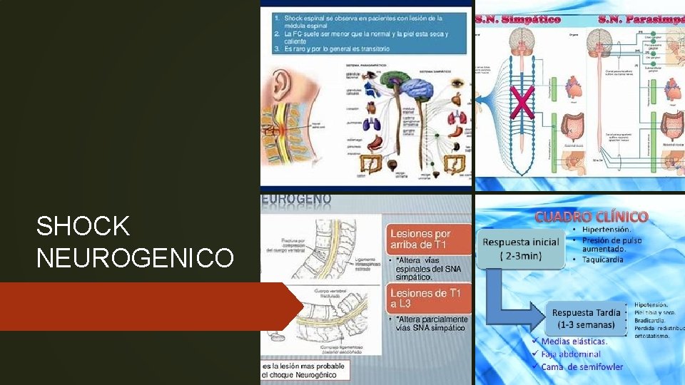 SHOCK NEUROGENICO 