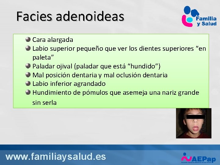 Facies adenoideas Cara alargada Labio superior pequeño que ver los dientes superiores “en paleta”