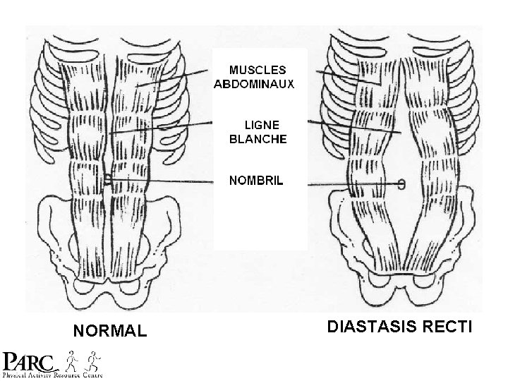 NORMAL DIASTASIS RECTI NORMAL DIASTASIS RECTI