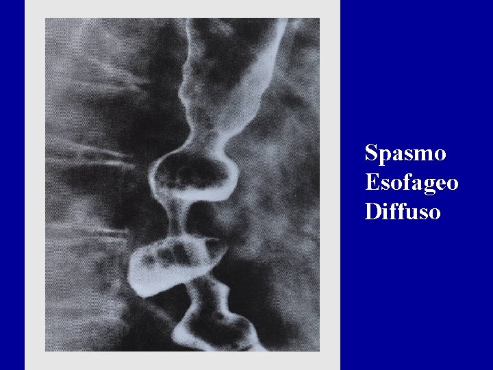 Spasmo Esofageo Diffuso 