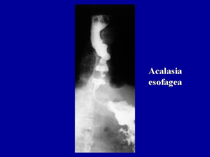 Acalasia esofagea 