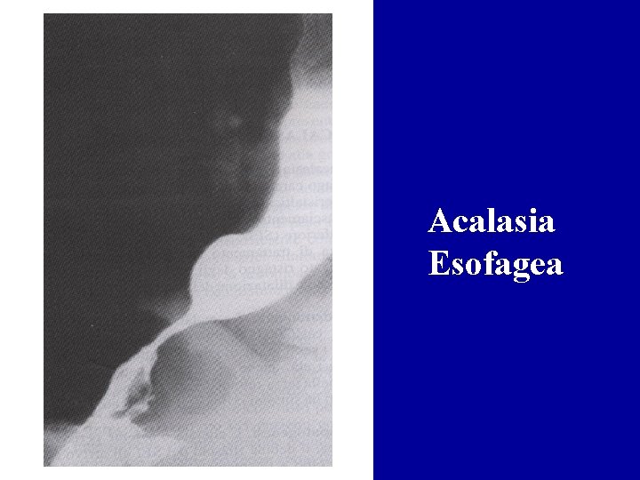 Acalasia Esofagea 