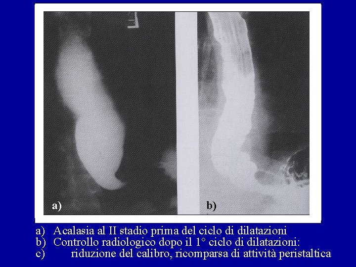 a) b) a) Acalasia al II stadio prima del ciclo di dilatazioni b) Controllo