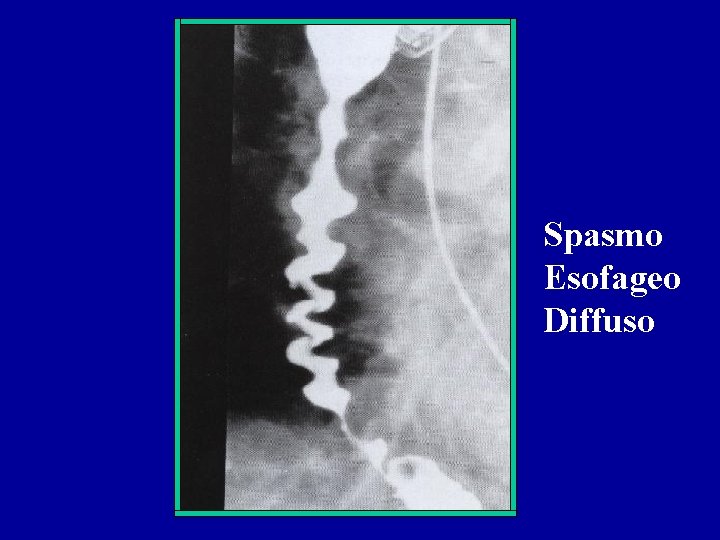 Spasmo Esofageo Diffuso 