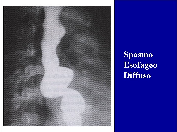 Spasmo Esofageo Diffuso 