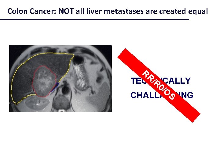 Colon Cancer: NOT all liver metastases are created equal RR /R TECHNICALLY 0/ O