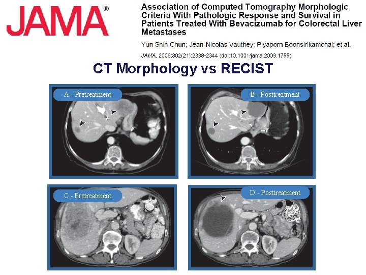 CT Morphology vs RECIST A - Pretreatment B - Posttreatment C - Pretreatment D