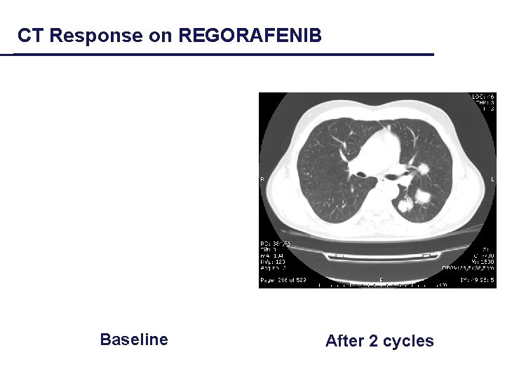 CT Response on REGORAFENIB Baseline After 2 cycles 