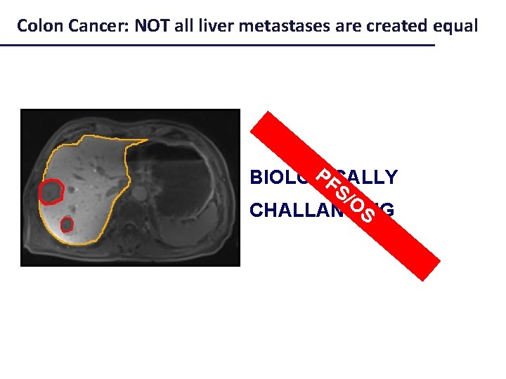 Colon Cancer: NOT all liver metastases are created equal PF BIOLOGICALLY S/ O S