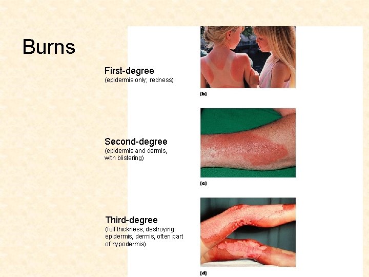 Burns First-degree (epidermis only; redness) Second-degree (epidermis and dermis, with blistering) Third-degree (full thickness,