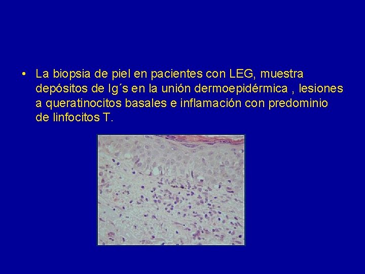  • La biopsia de piel en pacientes con LEG, muestra depósitos de Ig´s