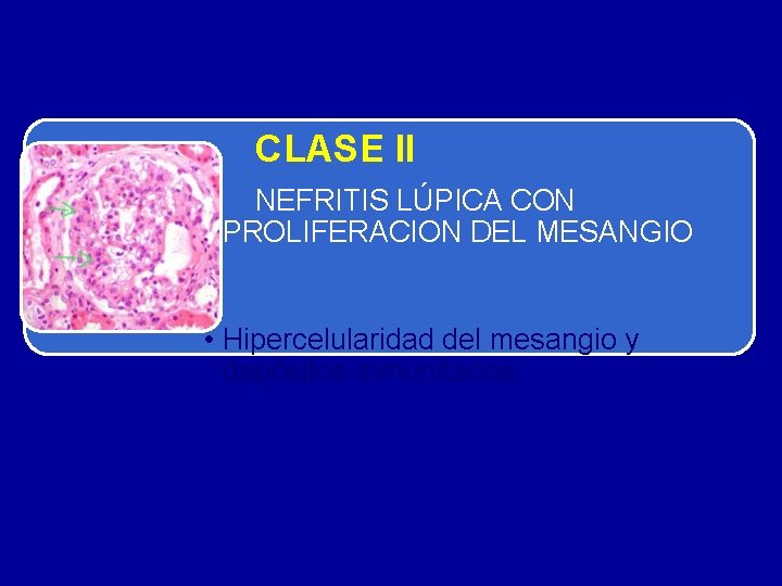 CLASE II • NEFRITIS LÚPICA CON PROLIFERACION DEL MESANGIO • Hipercelularidad del mesangio y