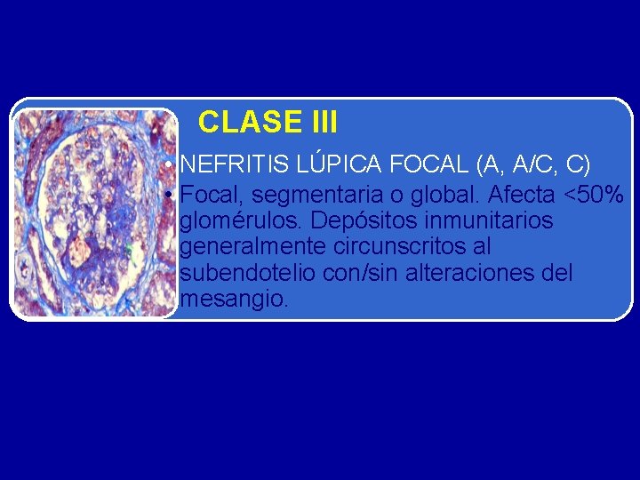 CLASE III • NEFRITIS LÚPICA FOCAL (A, A/C, C) • Focal, segmentaria o global.