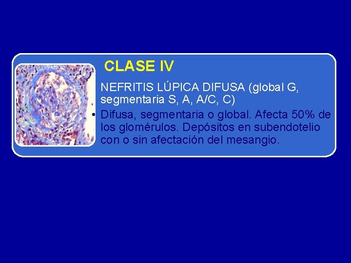 CLASE IV • NEFRITIS LÚPICA DIFUSA (global G, segmentaria S, A, A/C, C) •