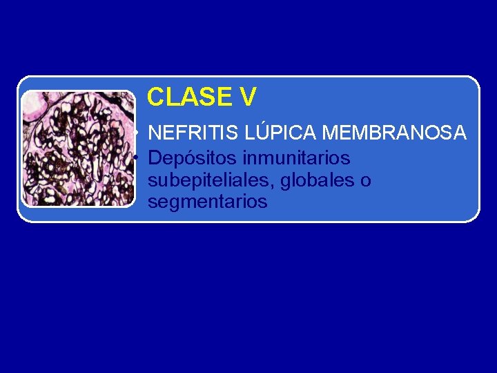 CLASE V • NEFRITIS LÚPICA MEMBRANOSA • Depósitos inmunitarios subepiteliales, globales o segmentarios 